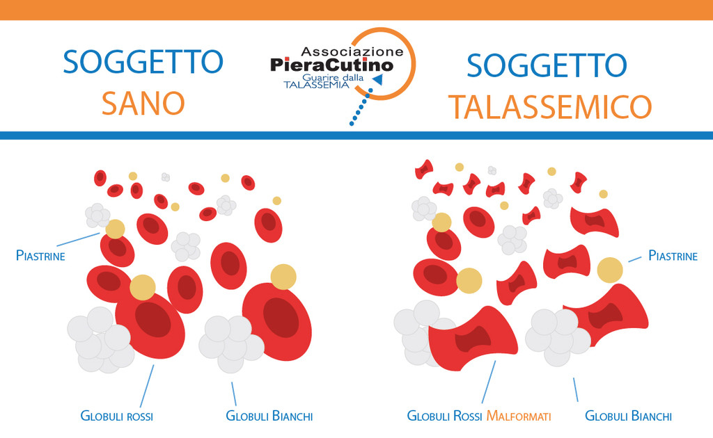 soggetto sano e soggetto talassemico